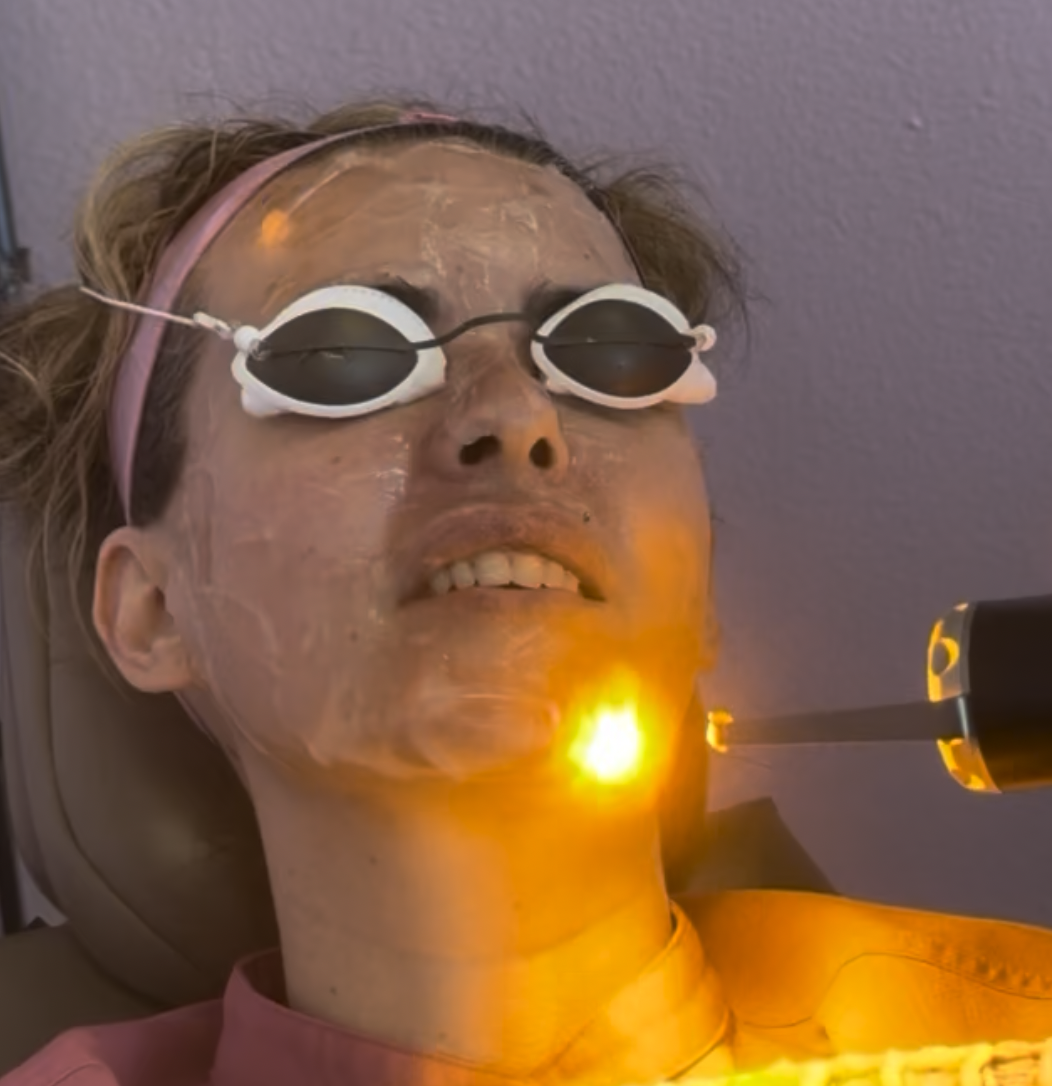 ADVATx laser treatment in progress at Storm Wellness Northwest