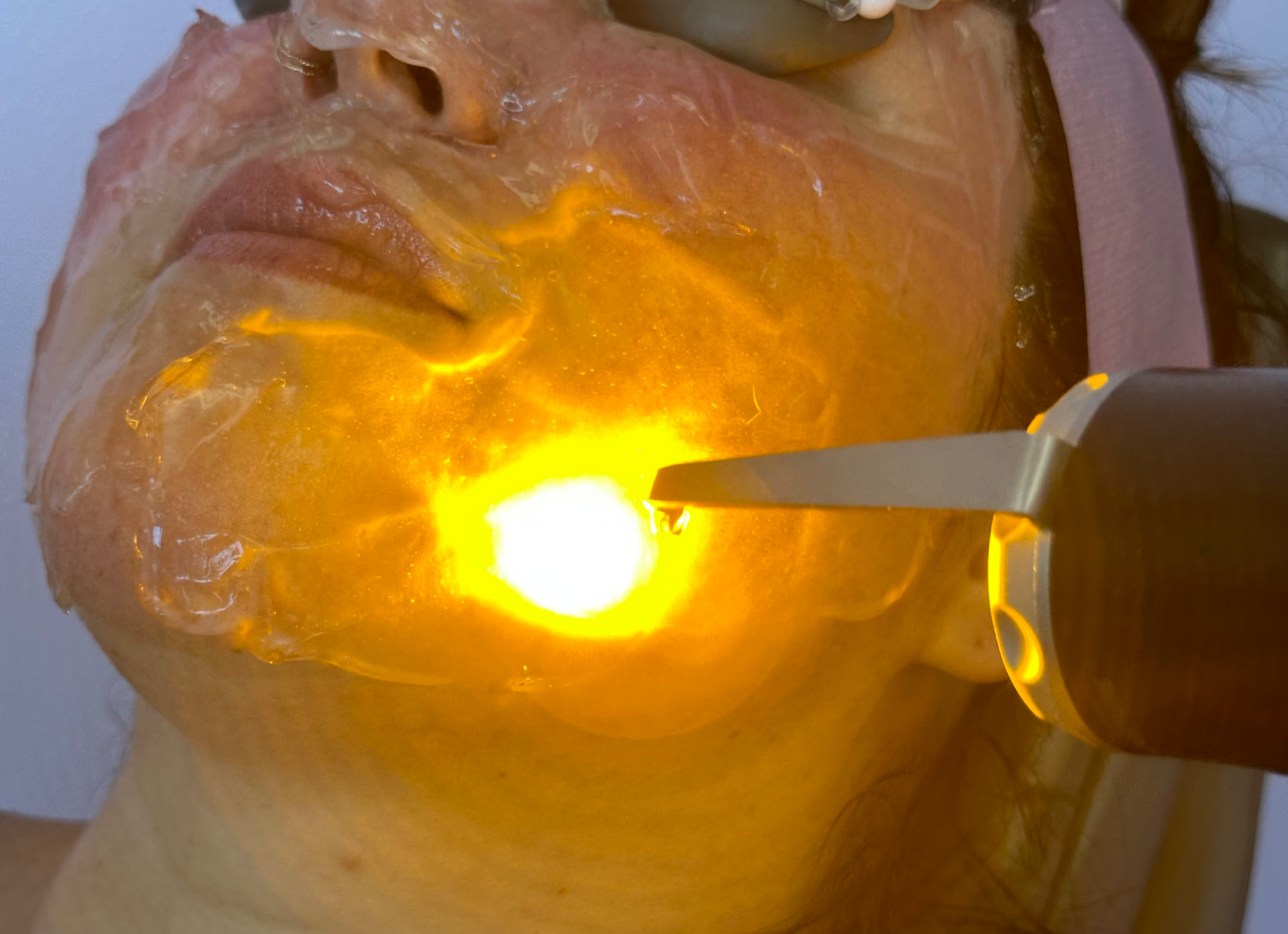 ADVATx laser treatment in progress at Storm Wellness Northwest